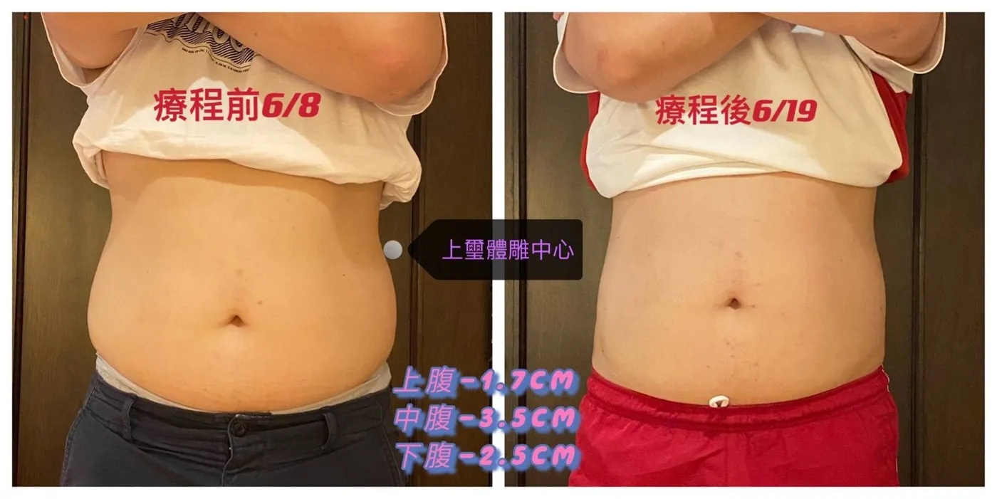 腹部療程前後對比：療程前 6/8 與療程後 6/19，上腹減少 1.7 公分、中腹減少 3.5 公分、下腹減少 2.5 公分